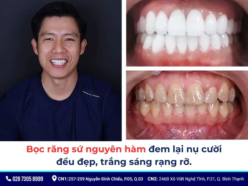 bọc răng sứ nguyên hàm