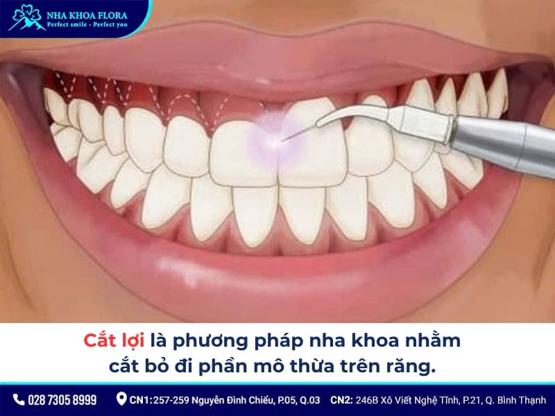 cắt lợi