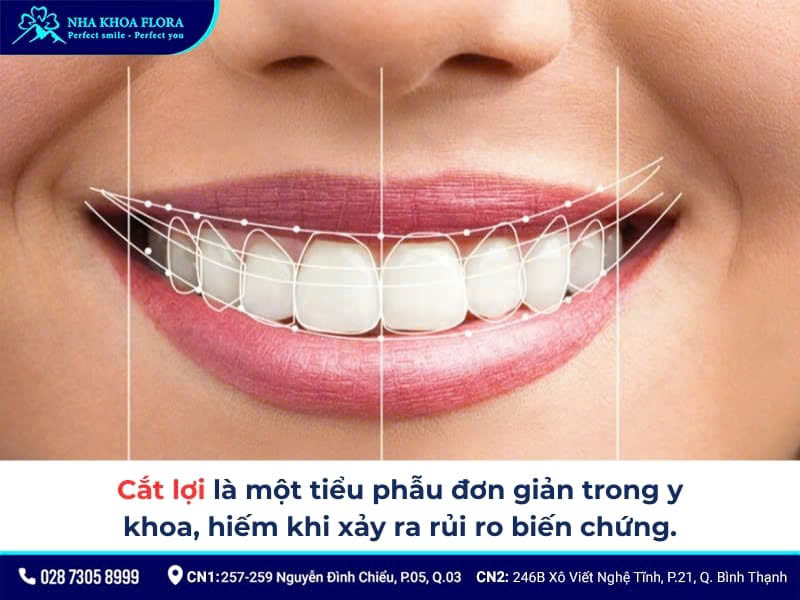 cắt lợi