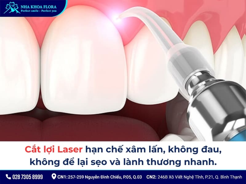 cắt lợi laser