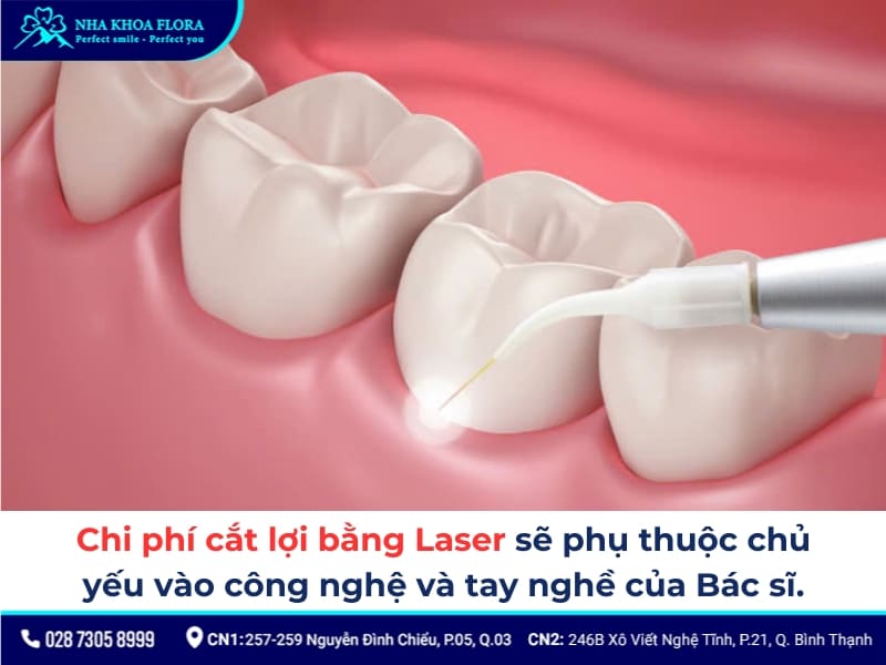 cắt lợi laser