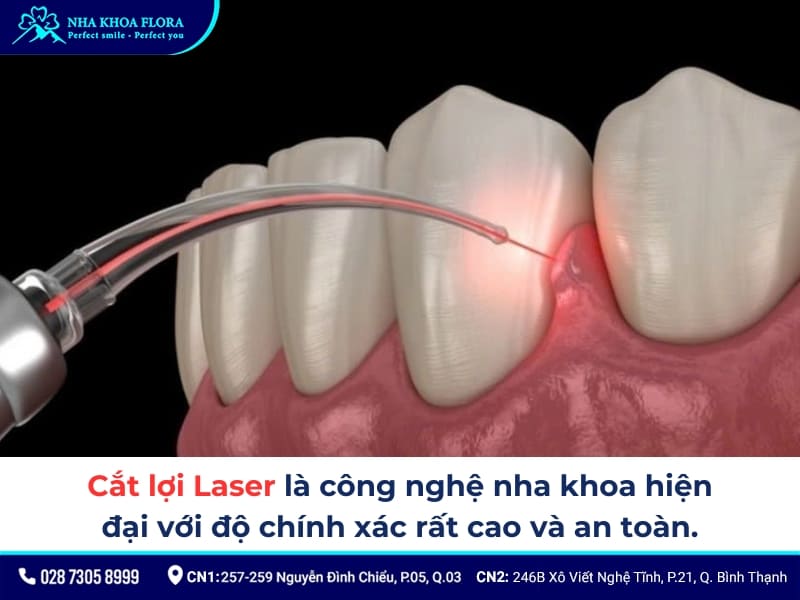 cắt lợi laser