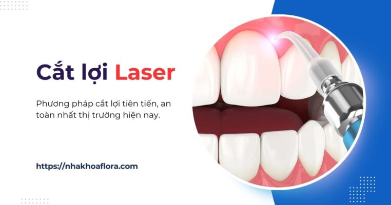 cắt lợi laser