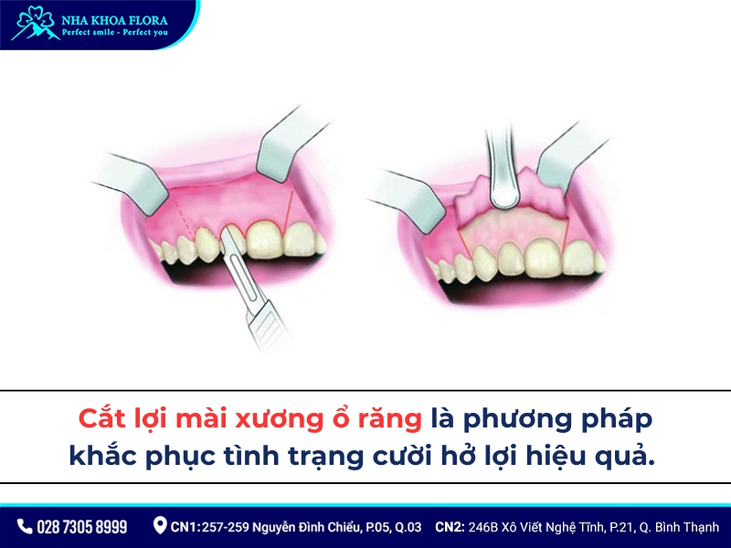 cắt lợi mài xương ổ răng