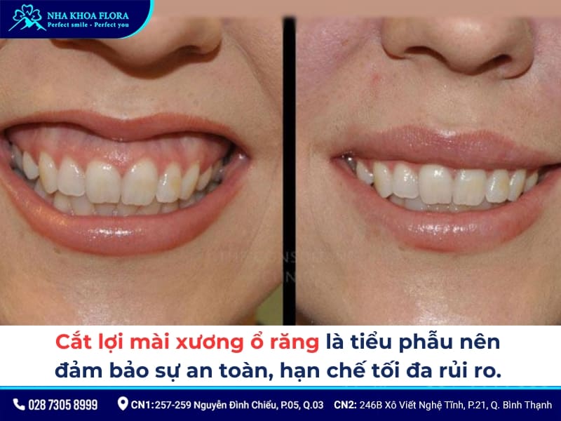 cắt lợi mài xương ổ răng