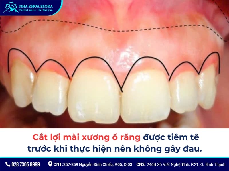 cắt lợi mài xương ổ răng