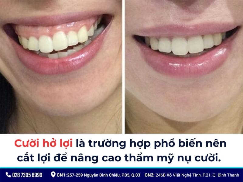 cắt lợi ở bệnh viện răng hàm mặt