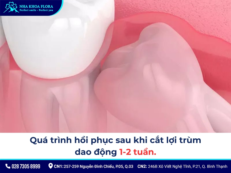 cắt lợi trùm