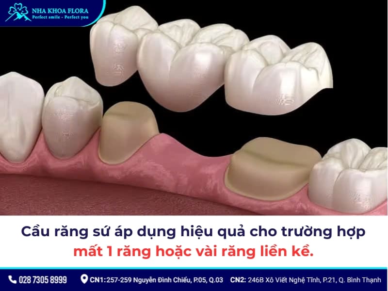 cầu răng sứ