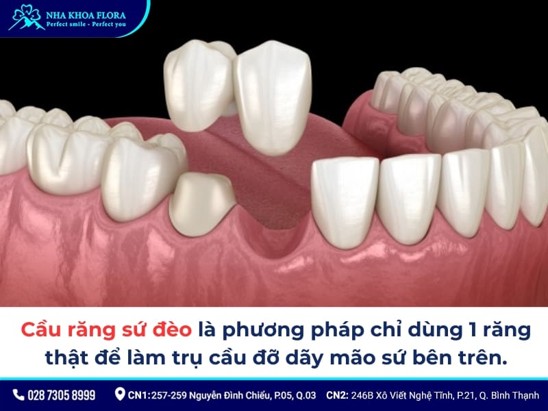 cầu răng sứ