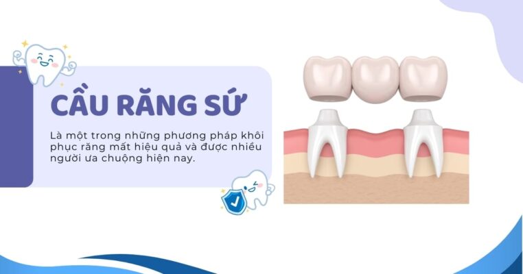 cầu răng sứ