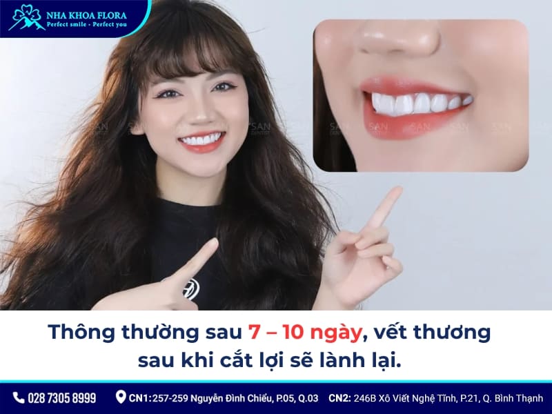 chi phí cắt lợi