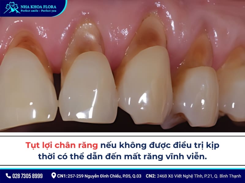 hở lợi chân răng