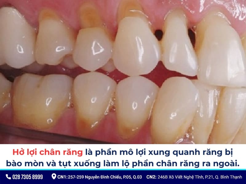 hở lợi chân răng