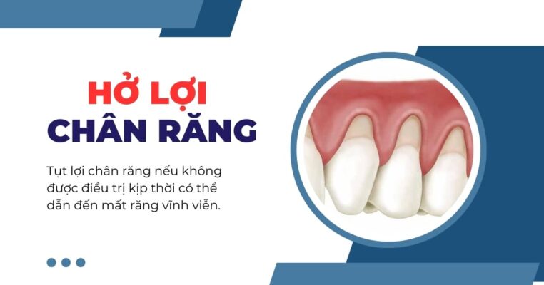 hở lợi chân răng