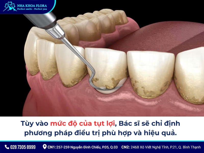 hở lợi chân răng