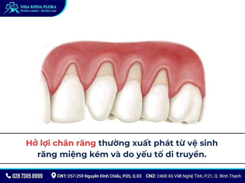 hở lợi chân răng