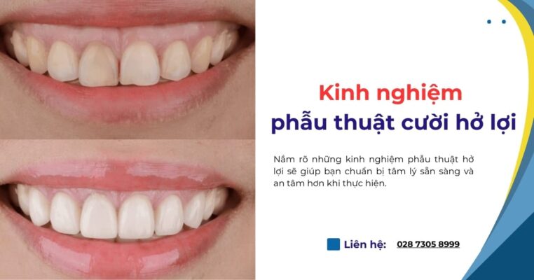 kinh nghiệm phẫu thuật cười hở lợi