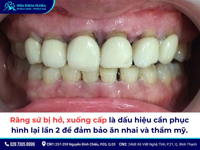 bọc răng sứ bao lâu thì phải làm lại