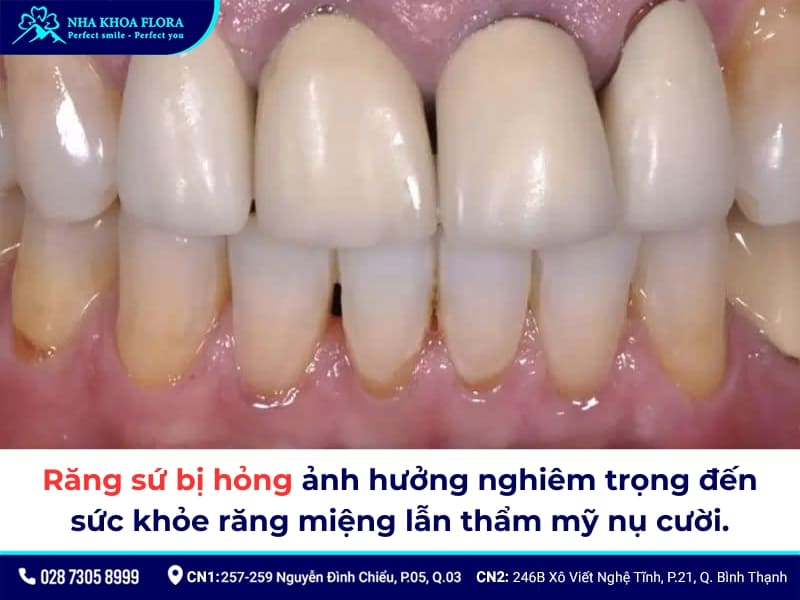 bọc răng sứ bị hỏng