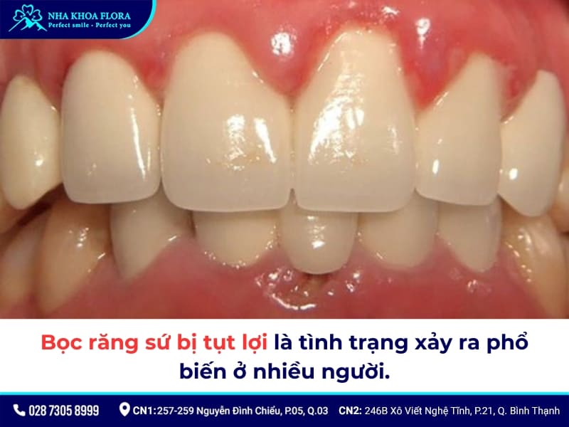 bọc răng sứ bị hỏng