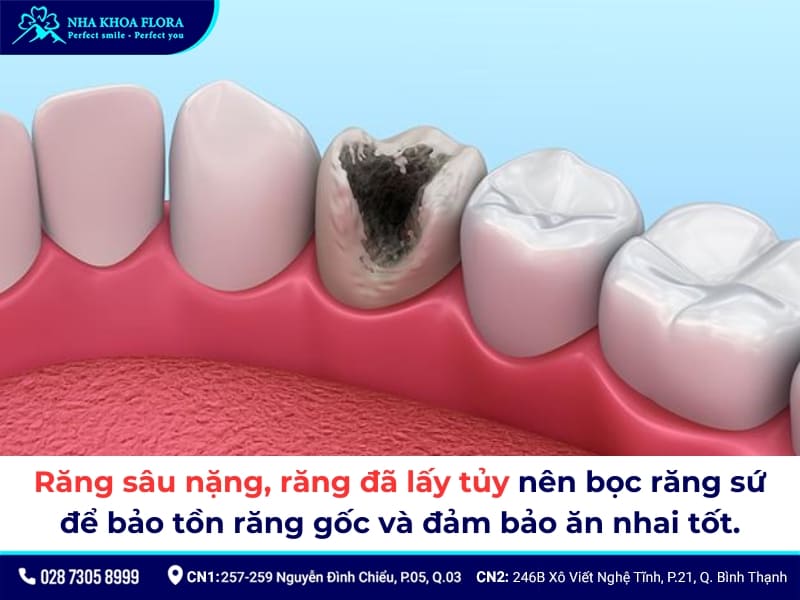 bọc răng sứ cho răng sâu