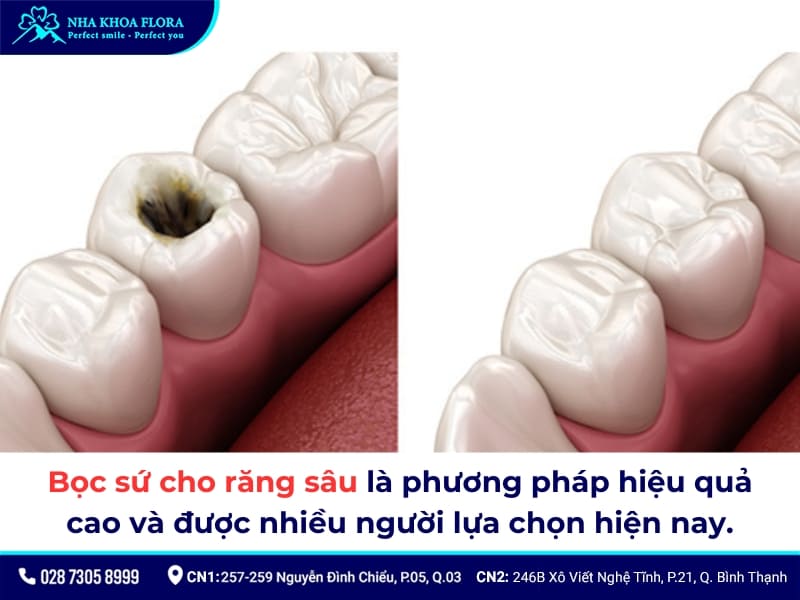 bọc răng sứ cho răng sâu
