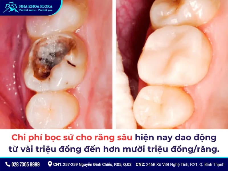 bọc răng sứ cho răng sâu