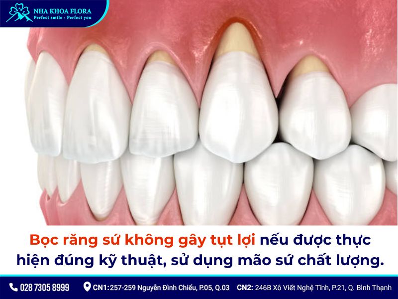 bọc răng sứ có bị tụt lợi không