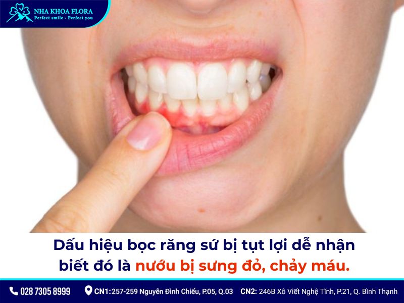 bọc răng sứ có bị tụt lợi không