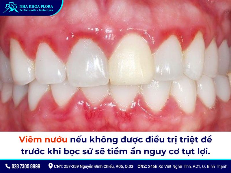 bọc răng sứ có bị tụt lợi không