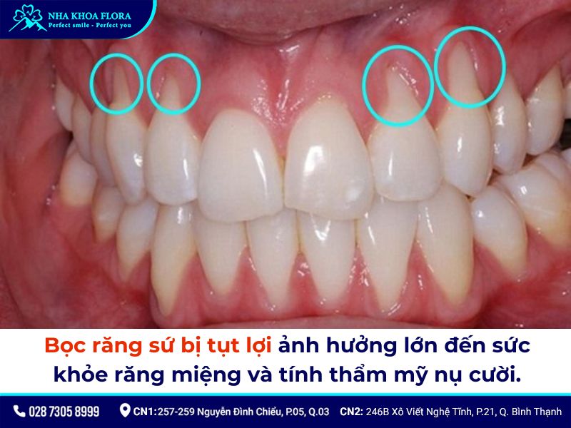 bọc răng sứ có bị tụt lợi không