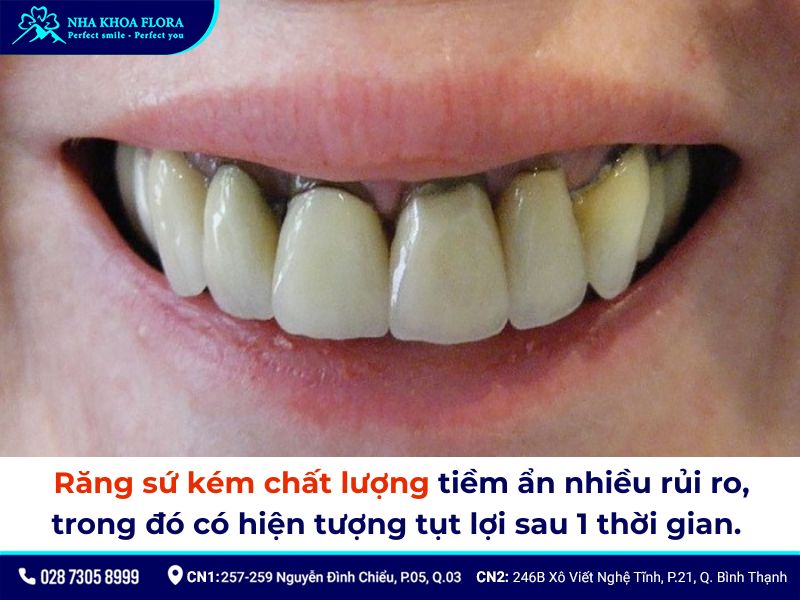 bọc răng sứ có bị tụt lợi không