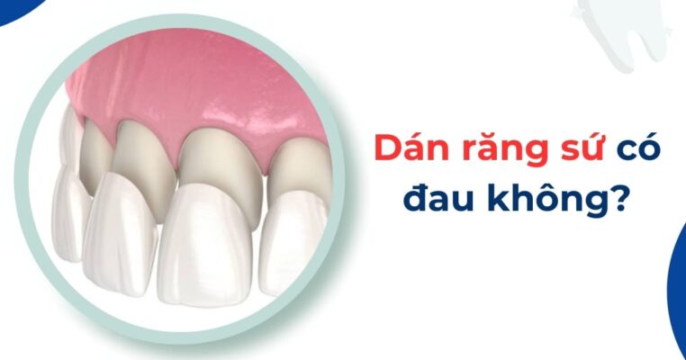 dán răng sứ có đau không