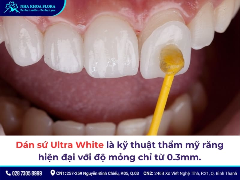 dán sứ ultra white