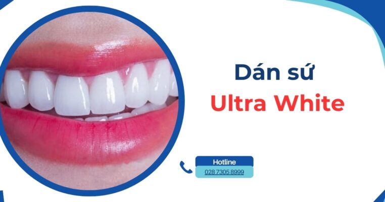 dán sứ ultra white