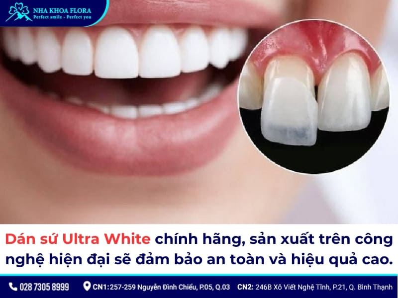 dán sứ ultra white