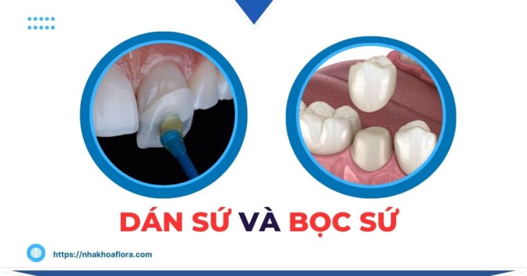 dán sứ và bọc sứ