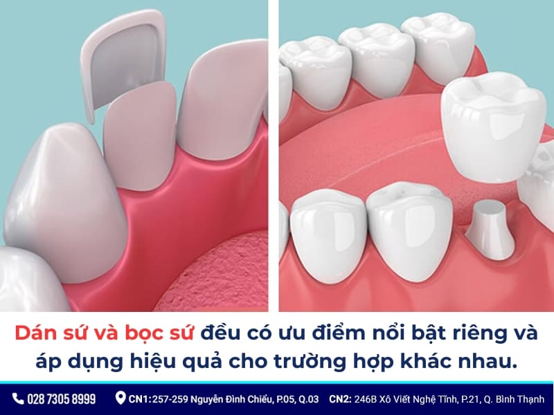 dán sứ và bọc sứ