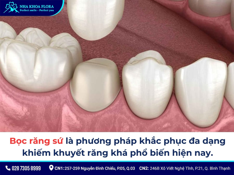 dán sứ và bọc sứ