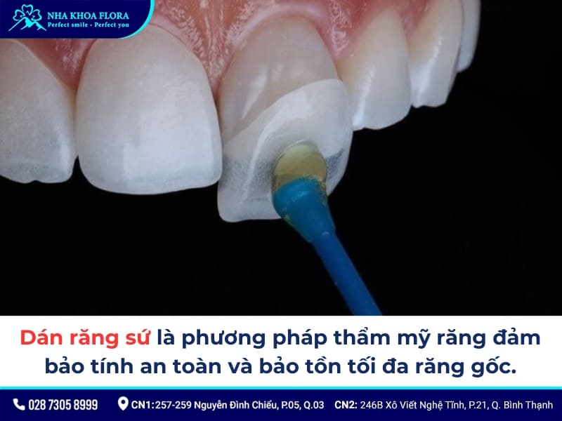 dán sứ và bọc sứ