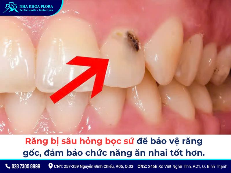 độ tuổi bọc răng sứ