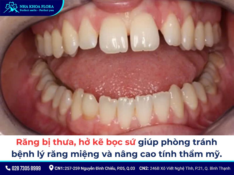 độ tuổi bọc răng sứ
