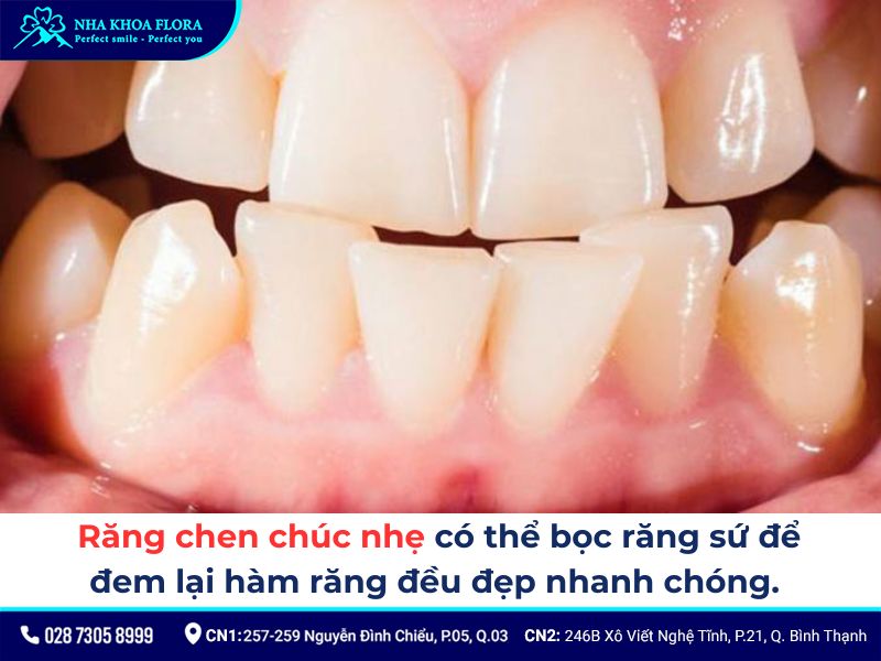 độ tuổi bọc răng sứ
