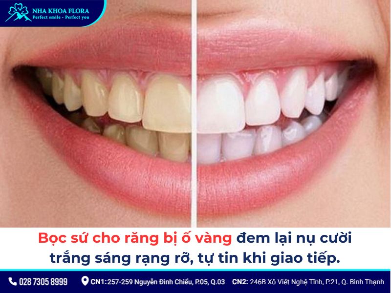 độ tuổi bọc răng sứ