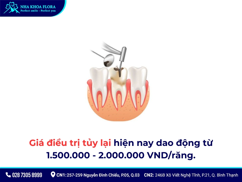 lấy tủy bọc răng sứ giá bao nhiêu