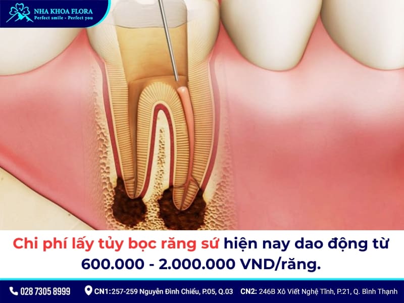 lấy tủy bọc răng sứ giá bao nhiêu
