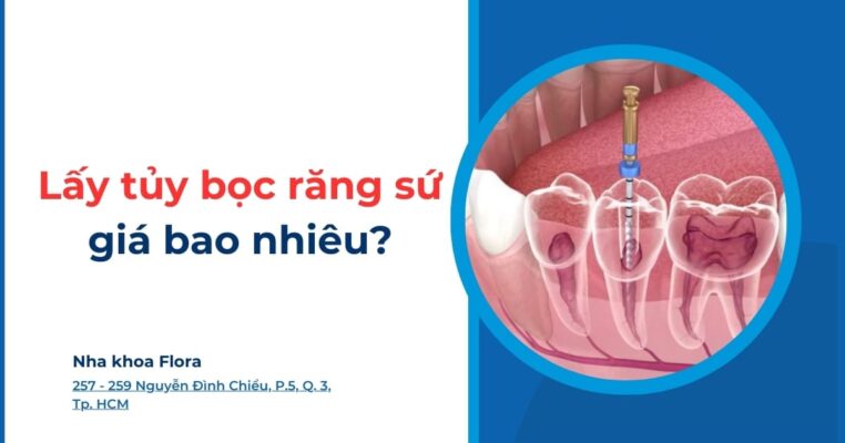 lấy tủy bọc răng sứ giá bao nhiêu