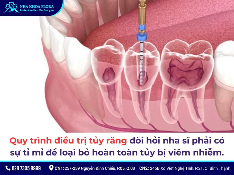 lấy tủy bọc răng sứ giá bao nhiêu