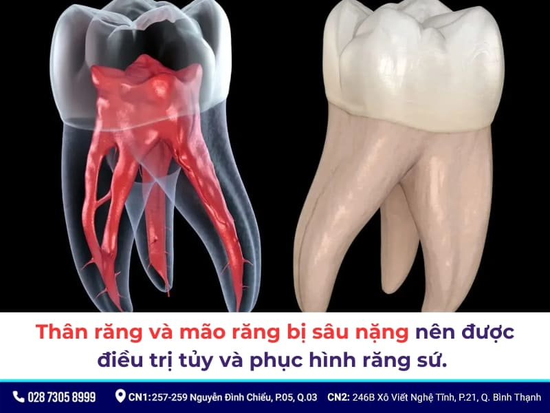 lấy tủy bọc răng sứ giá bao nhiêu